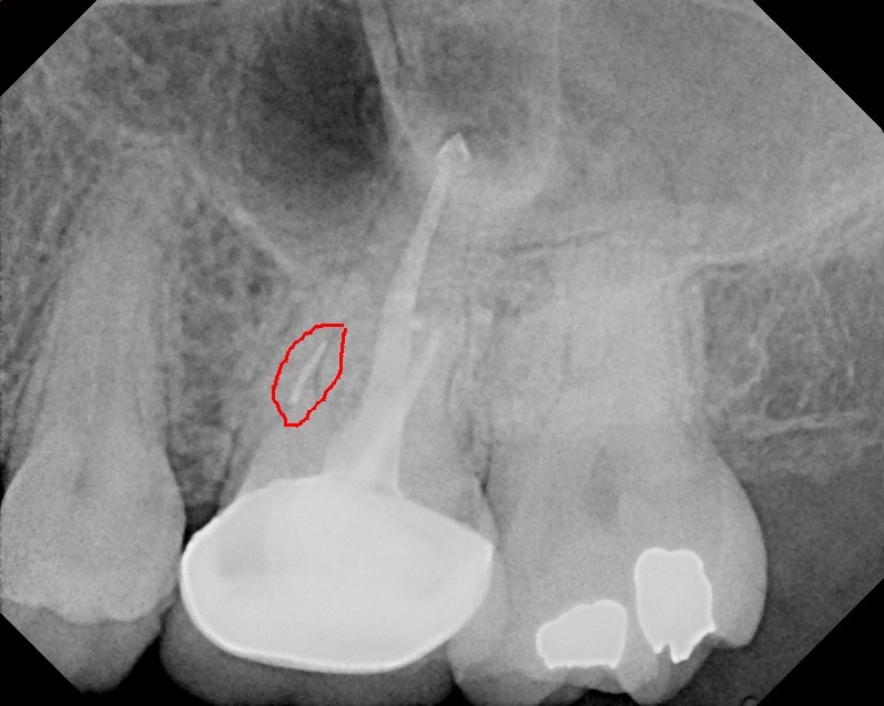 Previous root canal with separated file in the MB root on tooth #14. Patient was then referred to an endodontist.